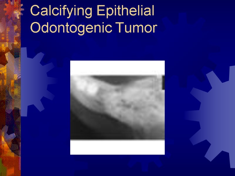 Calcifying Epithelial Odontogenic Tumor